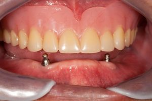 Можно ли моментально установить имплант в лунку только что удалённого зуба
