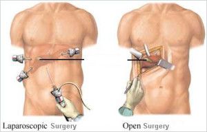 laparoscopys