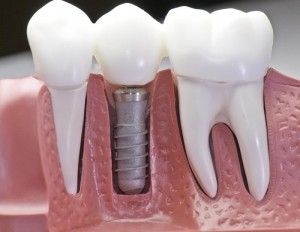 bigstock_Capped_Dental_Implant_Model_6941096