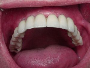 implantaciya-zubov-v-stomatologicheskom-otdelenie-kliniki-pervyj-doktor