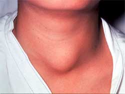 thyroid_tumor
