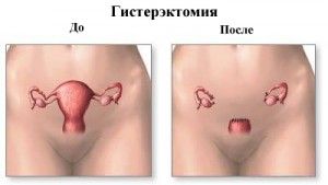 hysterectomy1-300x169