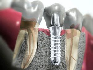 implantaciya-zubov-za-i-protiv