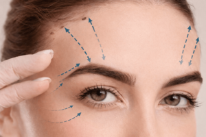 Подтяжка лба